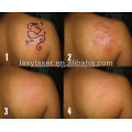 Tatouage machine nd yag laser removal